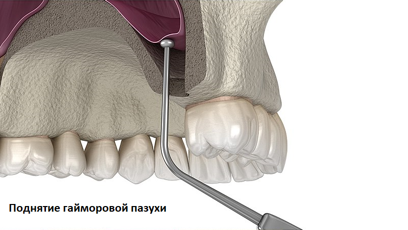 Синус лифтинг в стоматологии что это