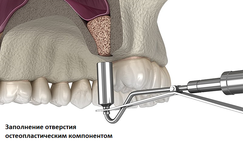 Синус лифтинг в стоматологии что это