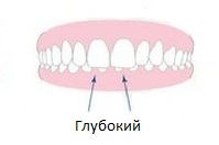 глубокий прикус