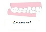 дистальный прикус