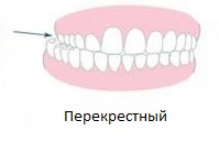 перекрестный прикус